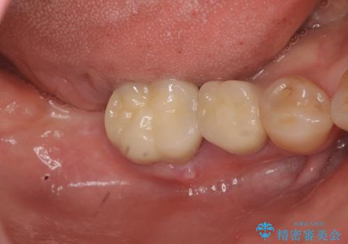 奥歯から膿のにおいがする インプラントによる機能回復の治療前