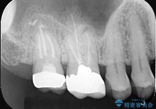 根尖性歯周炎|歯根嚢胞|インプラント治療の治療前