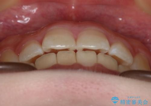 前歯のガタつきを治したい インビザライン・ライトパッケージの治療後