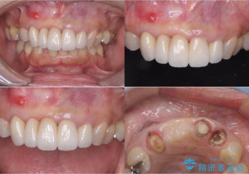 歯茎の腫れが気になる方必見!|抜歯即時インプラントで前歯5本を痛みなく3か月で治療完了!の治療前