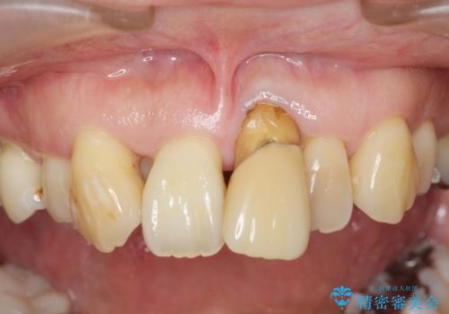 叢生(でこぼこ・八重歯)の症例 治療前