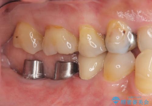 奥歯から膿のにおいがする インプラントによる機能回復の治療中