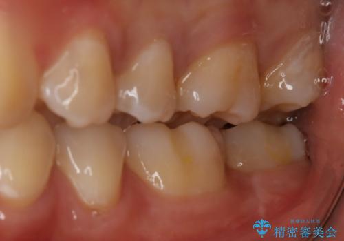 奥歯を治療したい フルジルコニアクラウンの治療前