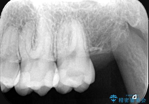 虫歯を治したい〈セラミック〉の治療前