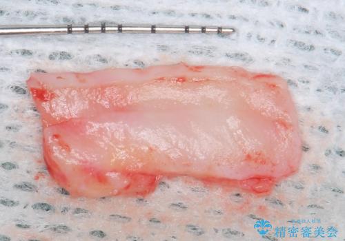 歯肉退縮に対する結合組織移植の治療中