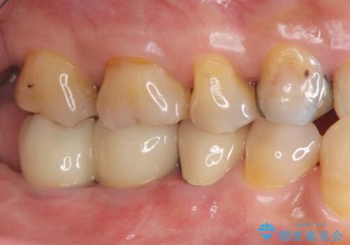 奥歯から膿のにおいがする インプラントによる機能回復の治療後