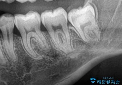 親知らずを抜きたい　親知らず抜歯の治療前