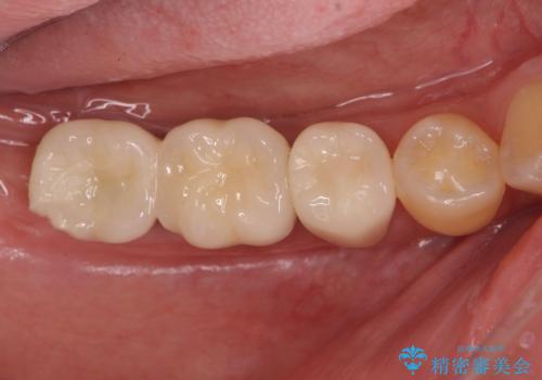 長期的な予後を見据えたインプラント治療の治療後