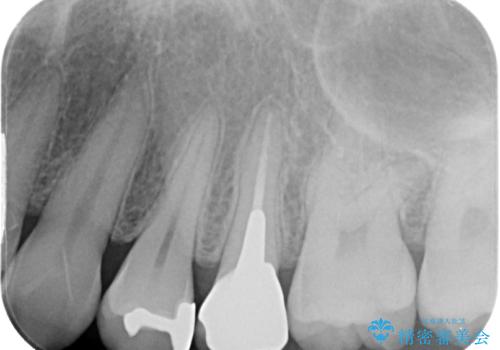笑った時に目立つ銀歯を治したい　オールセラミッククラウンの治療後