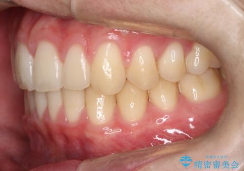 【ワイヤー矯正】すきっ歯を治したいの治療後