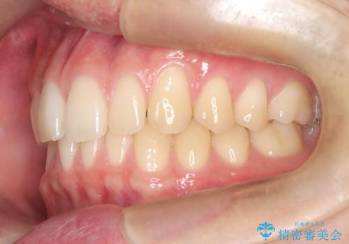 【ワイヤー矯正】すきっ歯を治したいの治療前