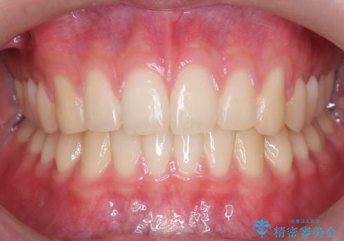 【ワイヤー矯正】すきっ歯を治したいの治療後