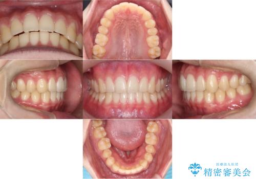 【ワイヤー矯正】すきっ歯を治したいの症例 治療後