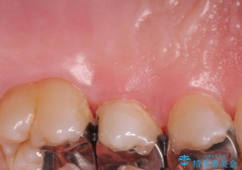 歯肉退縮に対する結合組織移植の治療前