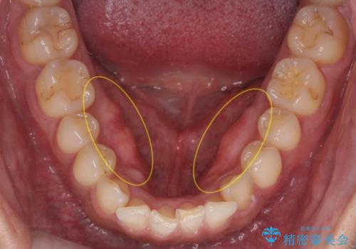 骨隆起を取りたい