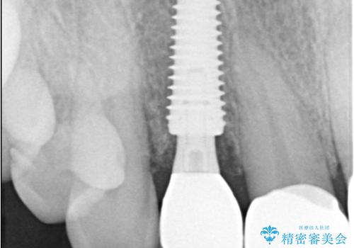 前歯の隙間とへこみが舌で触ると気になる|矯正治療は絶対にしたくない|抜歯即時インプラント+オールセラミッククラウンで審美修復の治療後