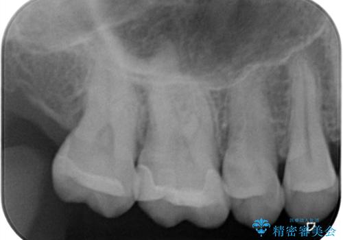 金属の被せ物を白くしたい【セラミックインレー】の治療後