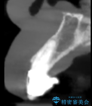 歯茎の腫れが気になる方必見!|抜歯即時インプラントで前歯5本を痛みなく3か月で治療完了!の治療中