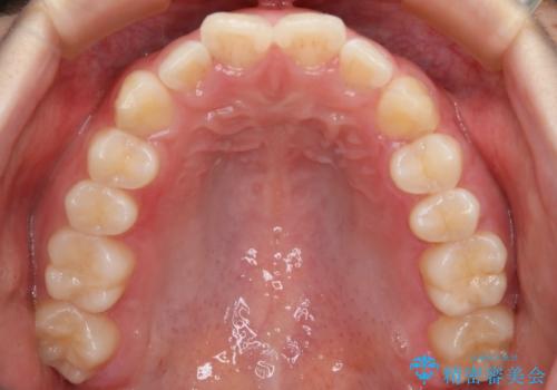 前歯のガタつきを治したい　インビザライン・ライトパッケージの治療前
