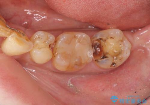 銀歯の下で虫歯の再発 拡大鏡下で行う虫歯の精密治療の治療中