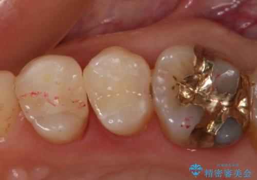 銀歯を白くしたい セラミックインレーの治療後