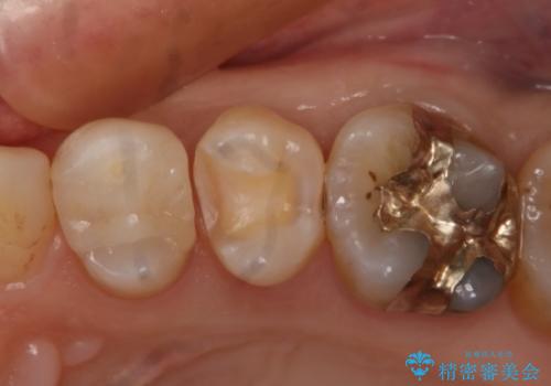 銀歯を白くしたい　セラミックインレーの治療中