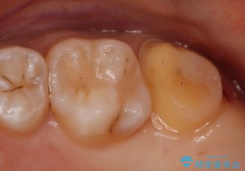 奥歯を治療したい　フルジルコニアクラウンの治療中