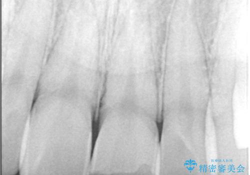 サーフィンで前歯をぶつけて歯が欠けた|かかりつけ医で治療困難と言われ当院へ来院|VPT(生活歯髄療法)で神経を保存|前歯の見た目も改善の治療前