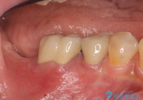 奥歯から膿のにおいがする インプラントによる機能回復の症例 治療前