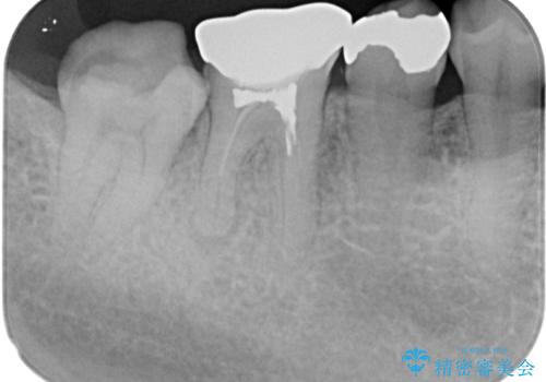 右下の銀歯が外れた オールセラミッククラウンの治療前