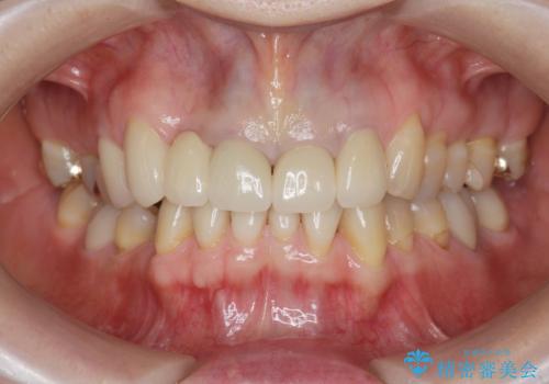 境目の見える前歯をきれいにしたい セラミック治療の治療後