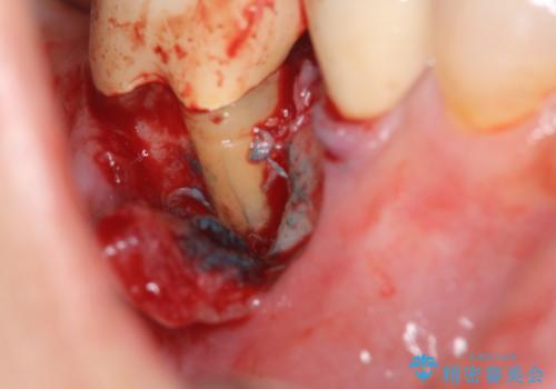 奥歯から膿のにおいがする インプラントによる機能回復の治療前