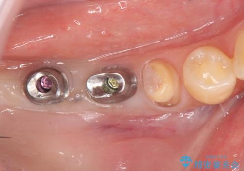 長期的な予後を見据えたインプラント治療の治療中