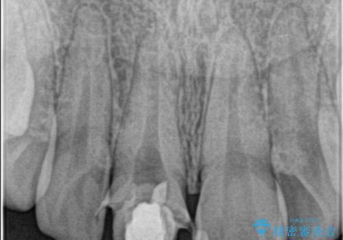 前歯が欠けた。の治療中