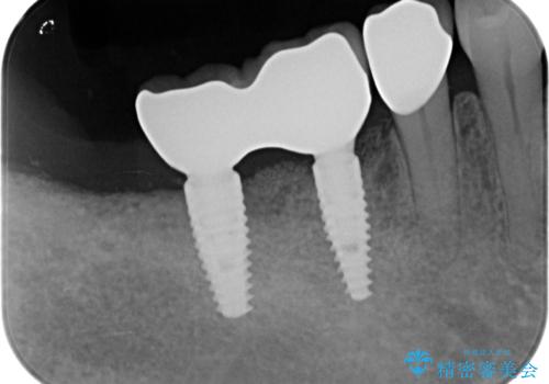 長期的な予後を見据えたインプラント治療の治療後