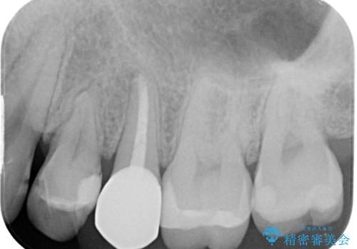 左上に違和感がある セラミックインレー修復の治療後