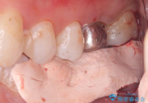 【歯牙移植】奥歯抜歯と言われたので親知らずを移植してほしいの治療中