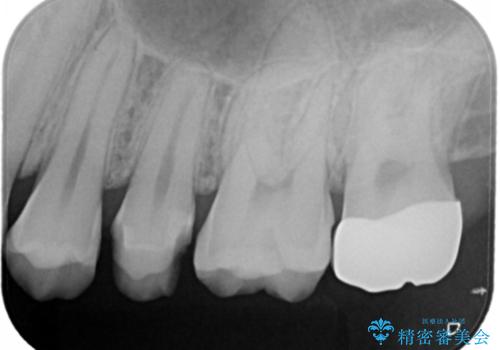 奥歯を治療したい フルジルコニアクラウンの治療後