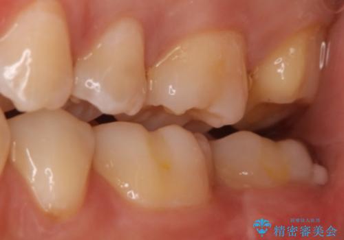 奥歯を治療したい フルジルコニアクラウンの治療中