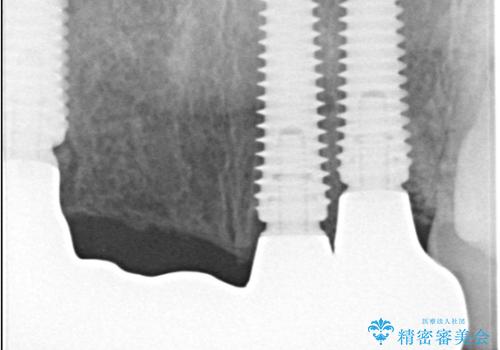 歯茎の腫れが気になる方必見!|抜歯即時インプラントで前歯5本を痛みなく3か月で治療完了!の治療後