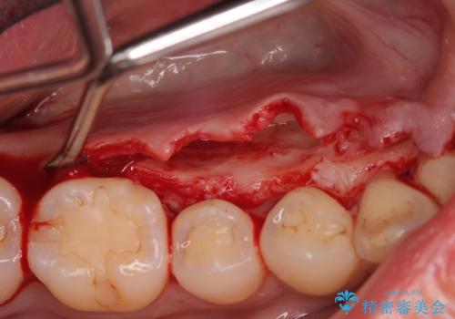 骨隆起を取りたいの治療前