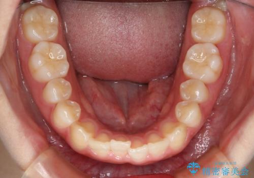 前歯のガタつきを治したい　インビザライン・ライトパッケージの治療前