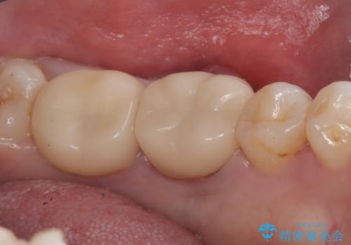 【歯牙移植】奥歯抜歯と言われたので親知らずを移植してほしいの治療前