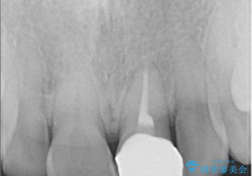 前歯の変色が気になる〈セラミッククラウン〉の治療後