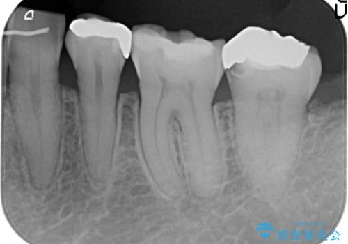 銀歯の下で虫歯の再発 拡大鏡下で行う虫歯の精密治療の治療前