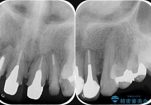境目の見える前歯をきれいにしたい セラミック治療の治療前