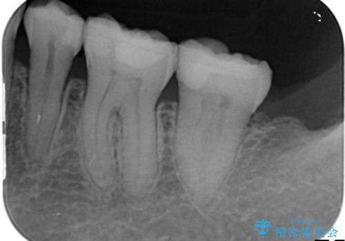銀歯の下で虫歯の再発 拡大鏡下で行う虫歯の精密治療の治療後
