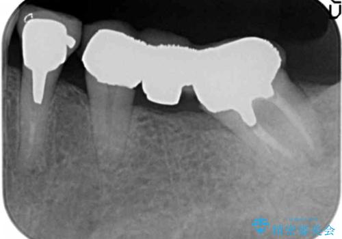 [ 不適合な補綴物による虫歯の再発 ]  劣化の進んだブリッジの再治療の治療前