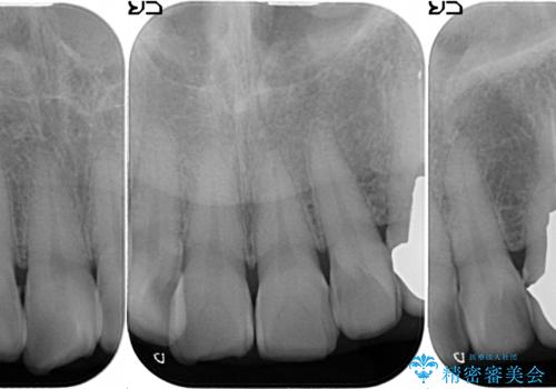 [ セラミック治療 ] 前歯の見た目を改善したいの治療前