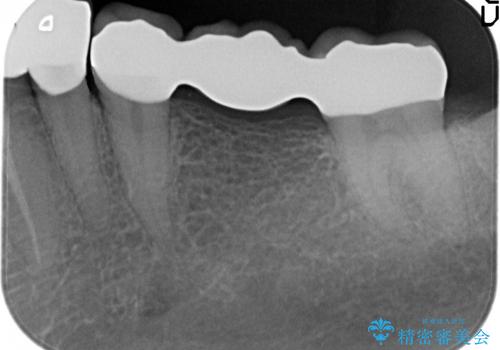 銀歯のブリッジをジルコニアブリッジへの治療後